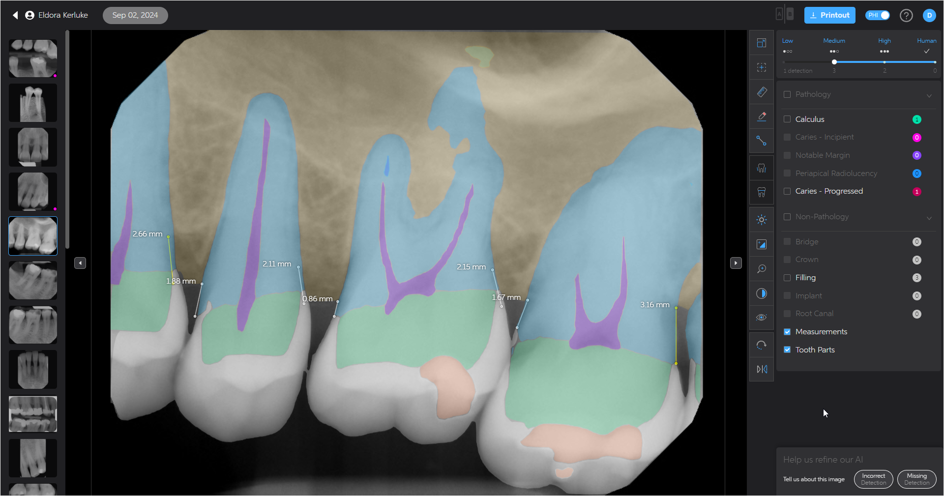 A screenshot of Second Opinion AI in EXACT